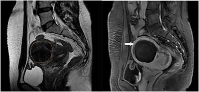 Physician Experience in Technical Success of Achieving NPVR ≥ 80% of High-Intensity Focused Ultrasound Ablation for Uterine Fibroids: A Multicenter Study